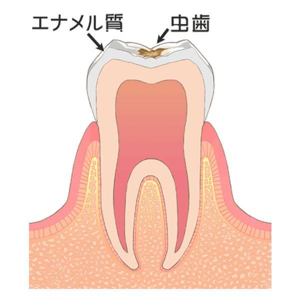 虫歯の始まり