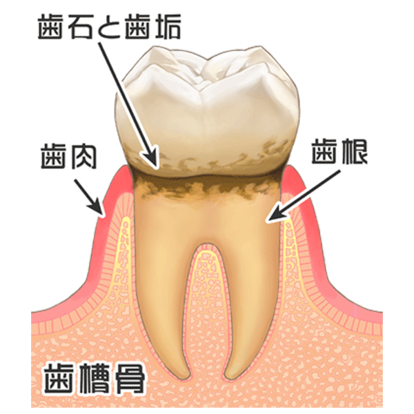 歯周病の始まり