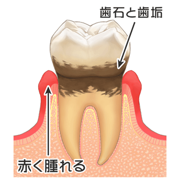 軽度～中度の歯周炎